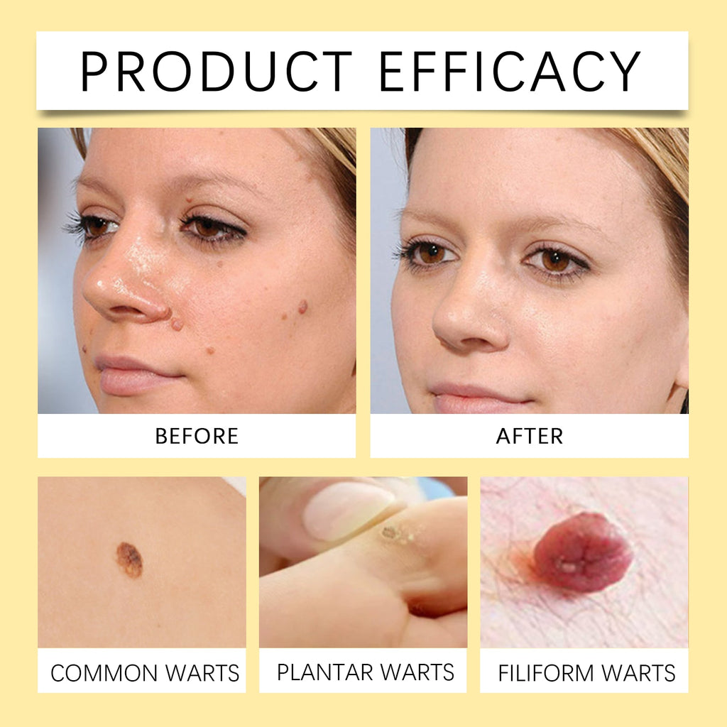 Bee Venom Wart & Mole Removal Spray, Gentle Cleansing Skin Moisturizing Moisturizing Smooth Skin Care
