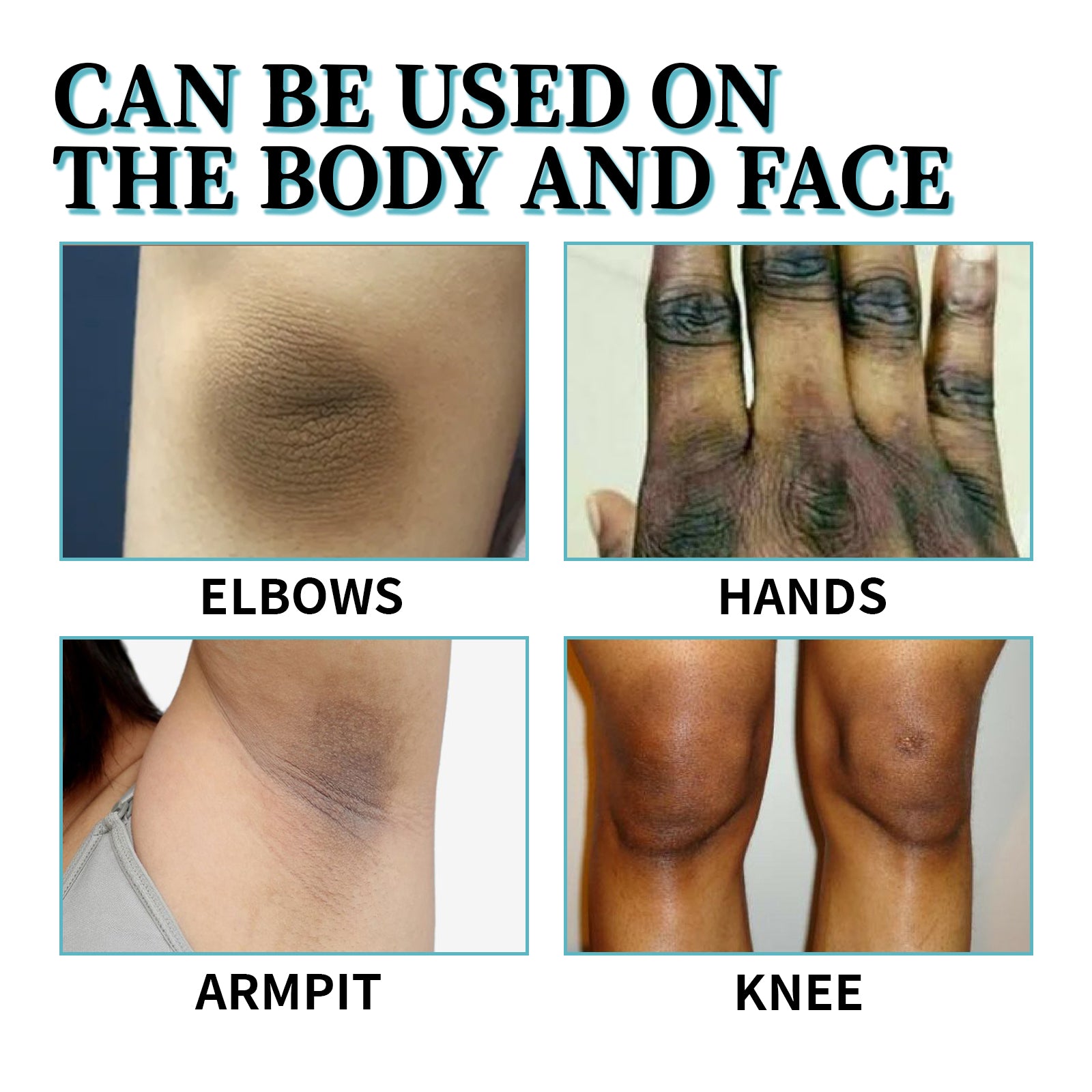 Acanthosis Nigricans Therapy Lotion, Skin Moisturizing Clean Black Dark Heavy Alar Knee Joint Repair Carry Bright Color Of Skin