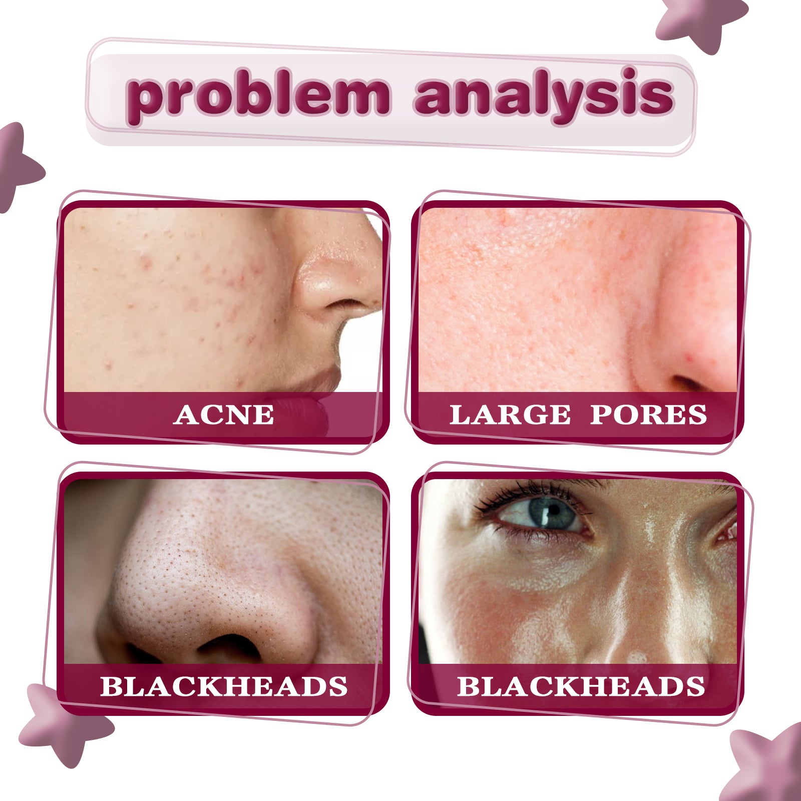 Acid Essence, Shrinks Pores, Removes Blackheads, Pimples And Acne Marks, Brightens Skin Tone Moisturizing Essence